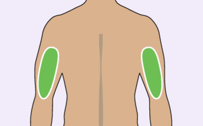 Diagram showing area for TRYNGOLZA injection: upper arm