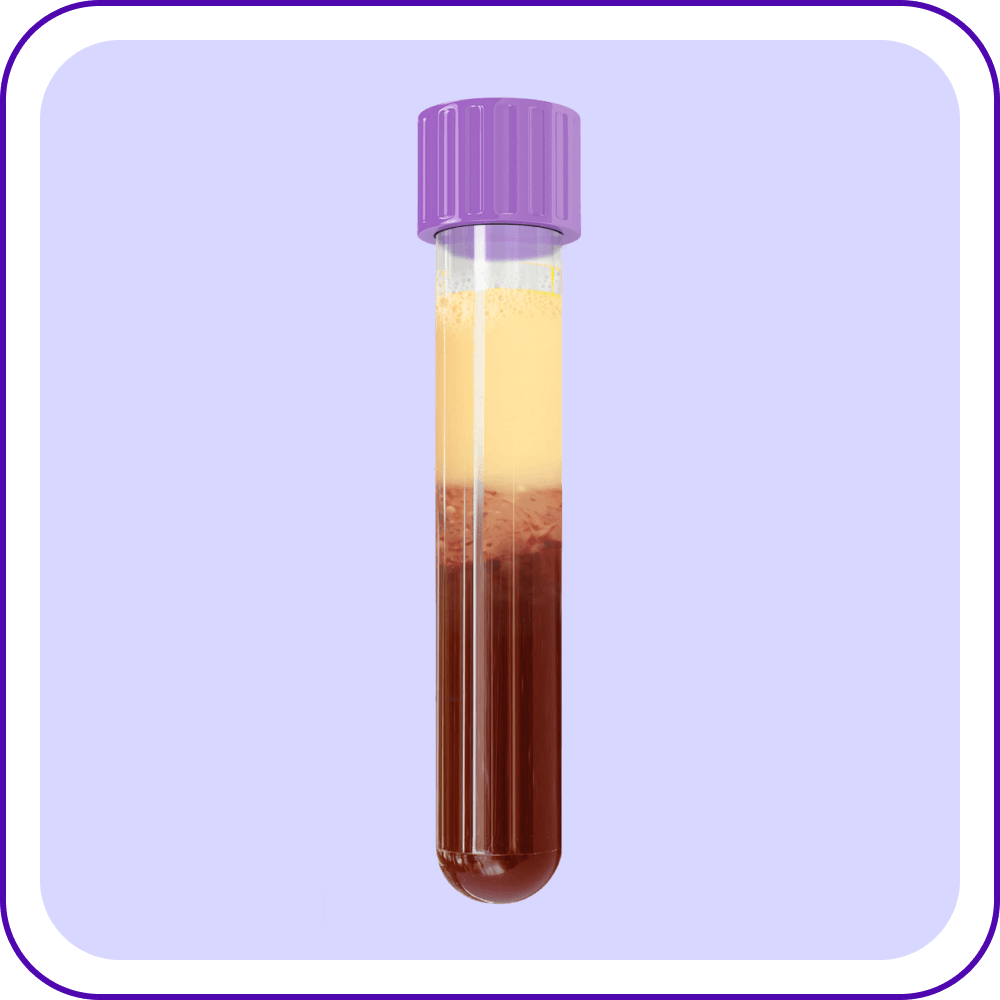 Blood Sample of a Patient with FCS Blood Sample of a Patient with FCS