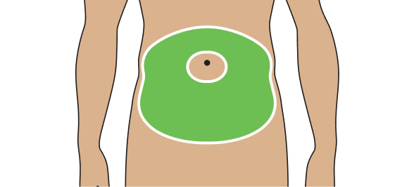 Diagram showing area for TRYNGOLZA injection: abdomen.