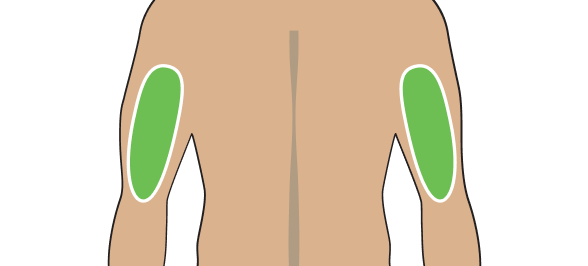 Diagram showing area for TRYNGOLZA injection: upper arm.